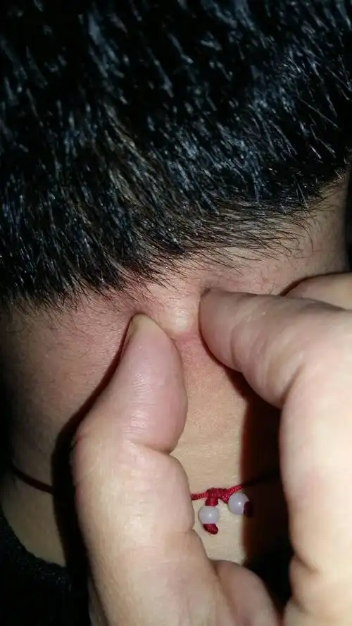 脖子后面原来长了一个粉刺,后来逐渐变硬了,也不疼