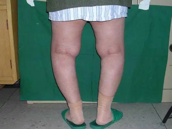 o型腿是如何形成的?与我们的走路方式有关么?有办法矫正吗?(有图)