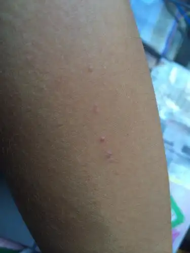 胳膊上这一排小疙瘩是啥东西?不疼不痒的.原来有两三个,一年又多俩.