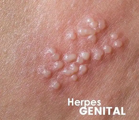 生值器单纯疱疹病毒hsv感染也比较常见