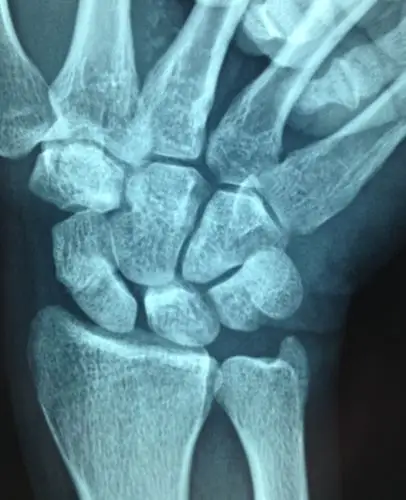 腕舟骨骨折