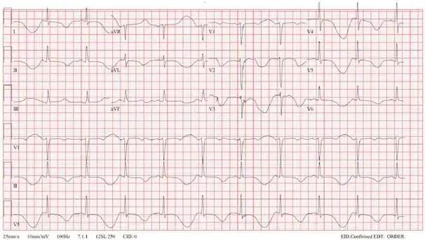 心电图挑战t波电交替现象