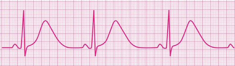 qt间期异常知多少轻松解读心电图