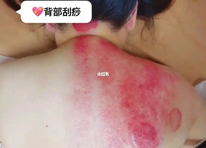 背部刮痧的好处