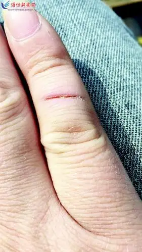 风筝线"行凶" 割伤骑车人