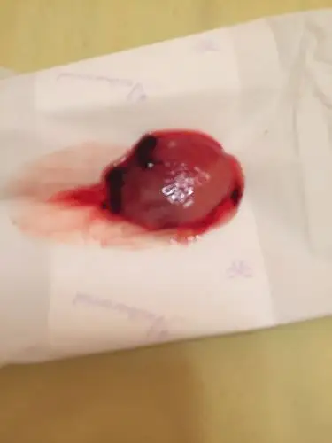 吃完米索一个半小时流出这个,是孕囊吗,因为复查需要等十几天,我想先