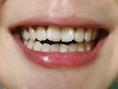 而且这么多天下来,牙齿的颜色越来越均匀了.