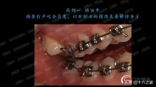 三例上颌磨牙颊侧倾斜引起正锁颌的矫治策略