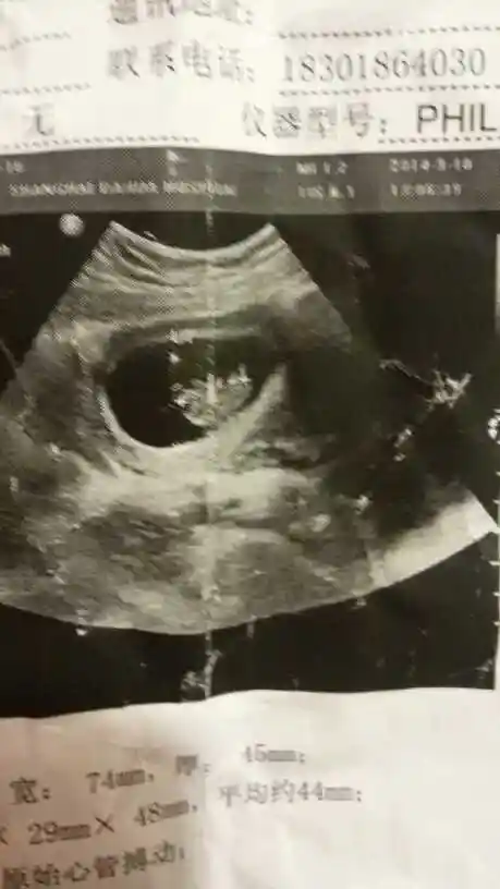 茄子状的孕囊是男孩子?