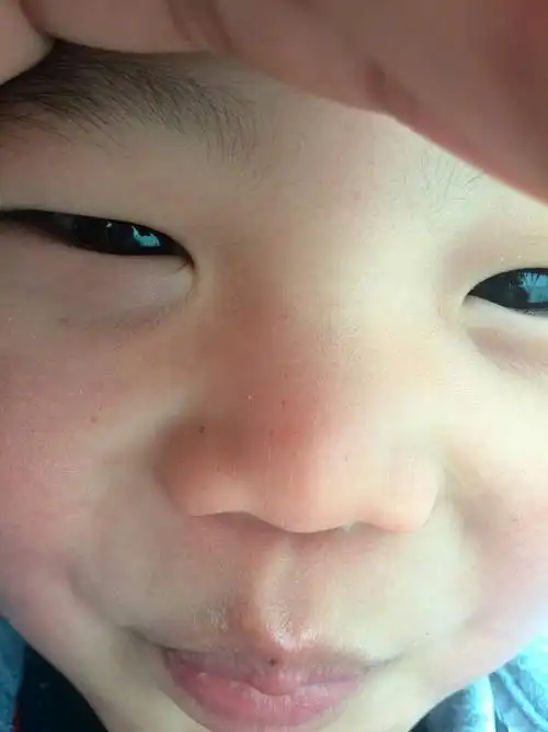 小孩脸上长雀斑有什么办法消掉