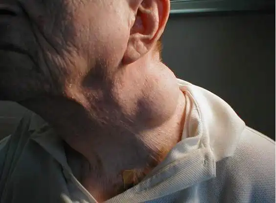 身上好多脂肪瘤怎么办(皮下长出这种肿块)