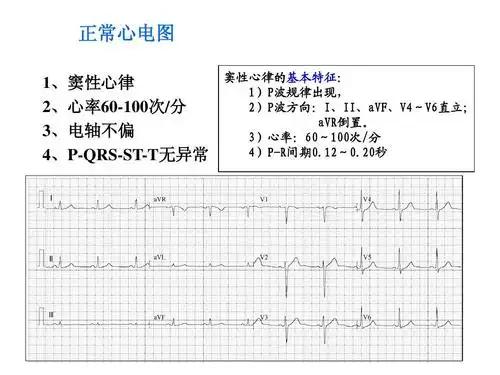 临床心电图教学ppt