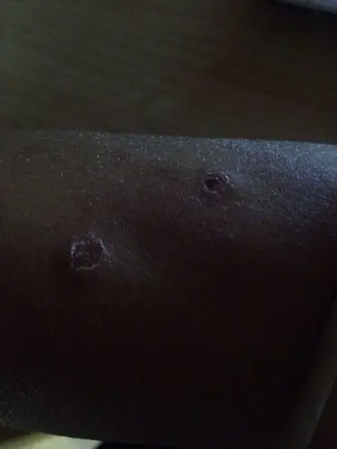 被跳蚤,虱子咬了是这样的吗