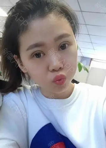 瑞瑞妮切开双眼皮术后第15天美丽日记_新氧整形