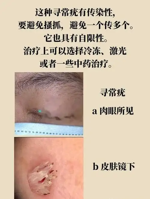 导语:脖子上有小肉疙瘩的原因主要考虑为皮赘和疣.