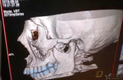 上颌骨骨折 [病例帖]