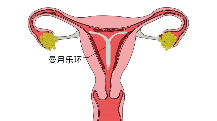 因部分患者子宫腔大,宫颈松弛或月经较多等原因,会导致曼月乐环下移