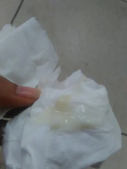 白带浓稠,复发好多次不知道怎么办了