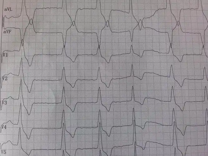 室性逸搏 - 心电图脑电图专业讨论版 - 爱爱医医学论坛