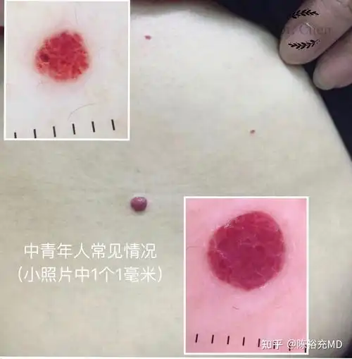 身上的小红点樱桃样血管瘤是怎么回事