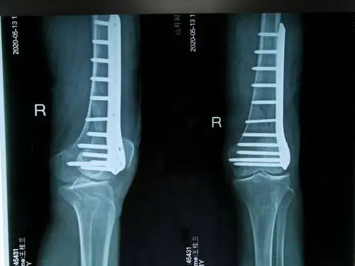 山丹县同和医院骨伤科为高龄女性患者行"股骨髁上粉碎性骨折"手术治疗