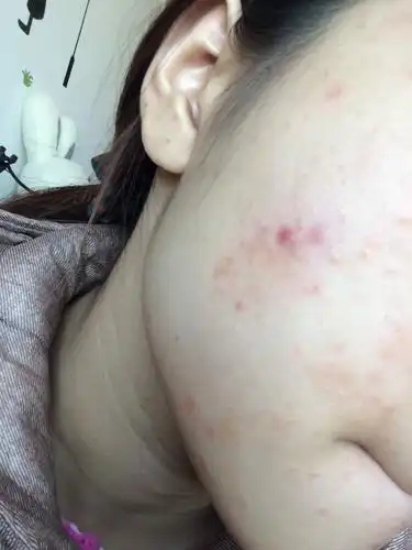 右脸颊长了一些闭合性粉刺,周一去医院看了皮肤科,医生说不太严重给开