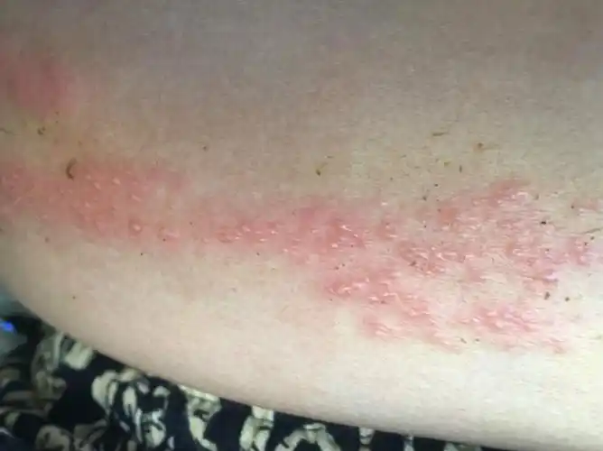 得了蛇缠腰每天疼的跟拿刀子划一样