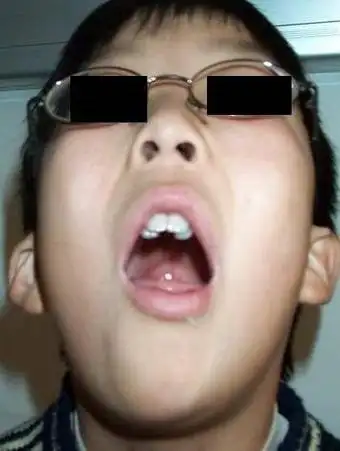 腺样体面容(颌骨变长,腭骨高拱,牙列不齐,上门牙往外突,变成龅牙)