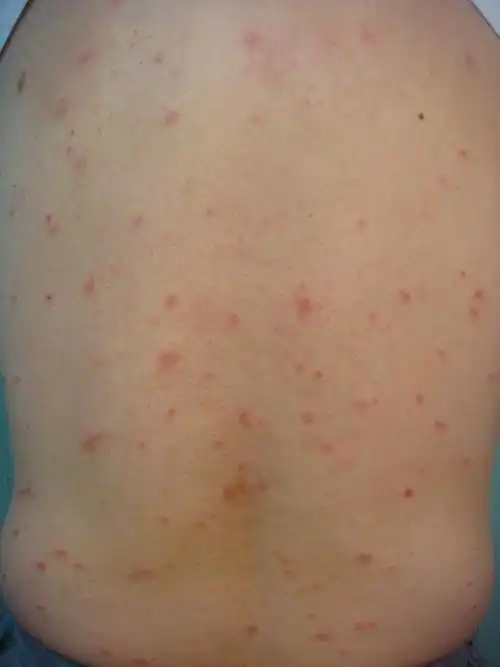 早期梅毒感染症状图图片