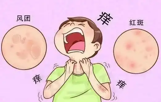 一,荨麻疹是种什么病所谓的"荨麻疹"又叫"风疹块",是皮肤黏膜由于暂时