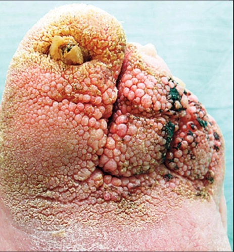 图中小的菜花样的凸起,其实叫"指状疣",是寻常疣的一种.