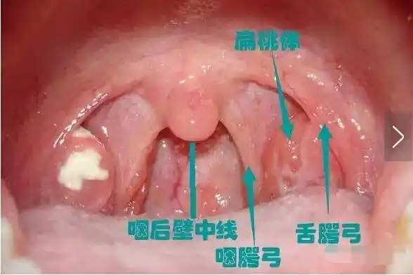扁桃体肿大的三度划分一度二度三度讲解