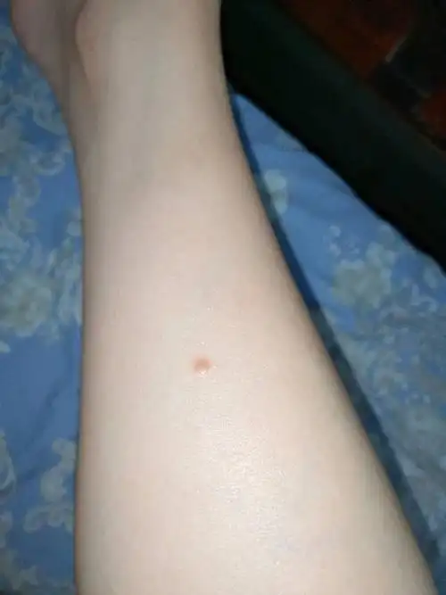 小腿上长了一个小疙瘩,不痛不痒,一年多了,没有变大,是什么?