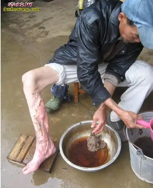 眼镜蛇咬伤症状