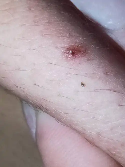 家里出现了好多这种虫子,被咬了之后就像被蚊子咬一样红肿痒,好多好多