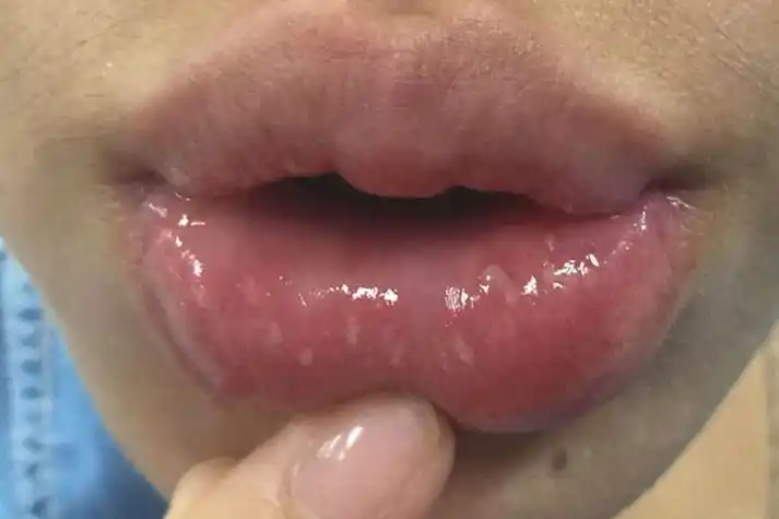 口腔带状疱疹疱疹症状图