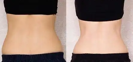 腹部吸脂的适应症有哪些