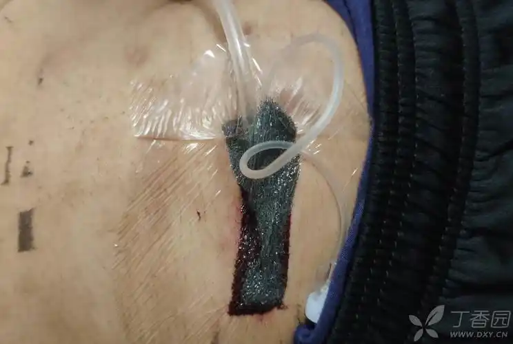 腰部脂肪瘤术后的切口7月不愈合,如何处理?