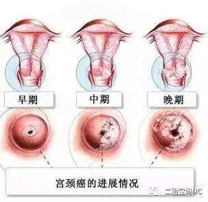 关爱女性健康做好宫颈检查