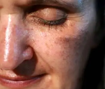 脸斑脸上有色素斑.脸颊色素沉着照片