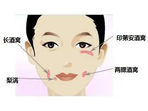 这种酒窝长在脸两边的腮骨上,笑起来比较像一个凹下去的小坑