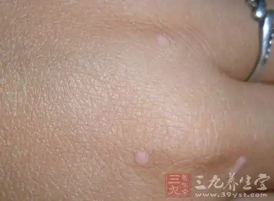 我和扁平疣的5年之恋