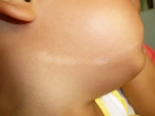 典型病例线状苔藓