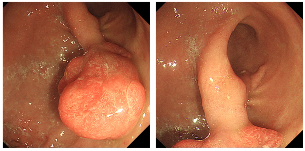 这样的胃息肉你见过吗