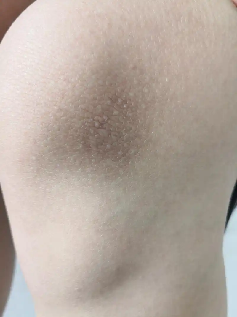 膝关节周围皮肤干燥粗糙 ,苔藓样变斑块.有过敏体质病史和家族史.