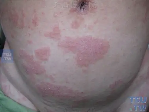 同一病人,腹部皮损,表面有细碎鳞屑