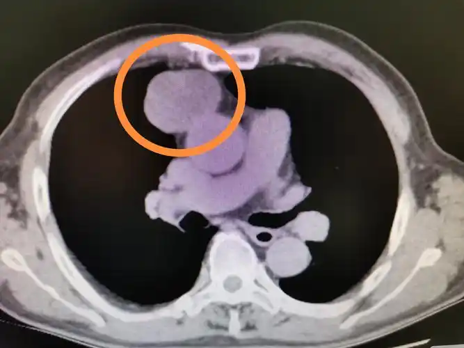 纵隔肿瘤的快速康复 - 好大夫在线