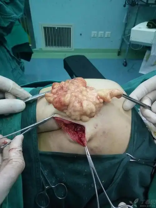 手术顺利.术后病理:脂肪瘤.