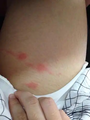 问:大腿内侧长了红疙瘩微痒痛