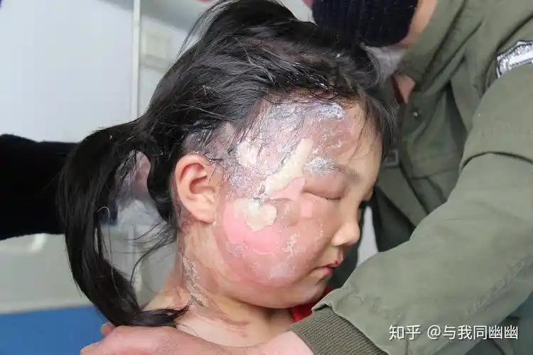 长沙哪家医院治疗儿童烧烫伤比较好不需要植皮的